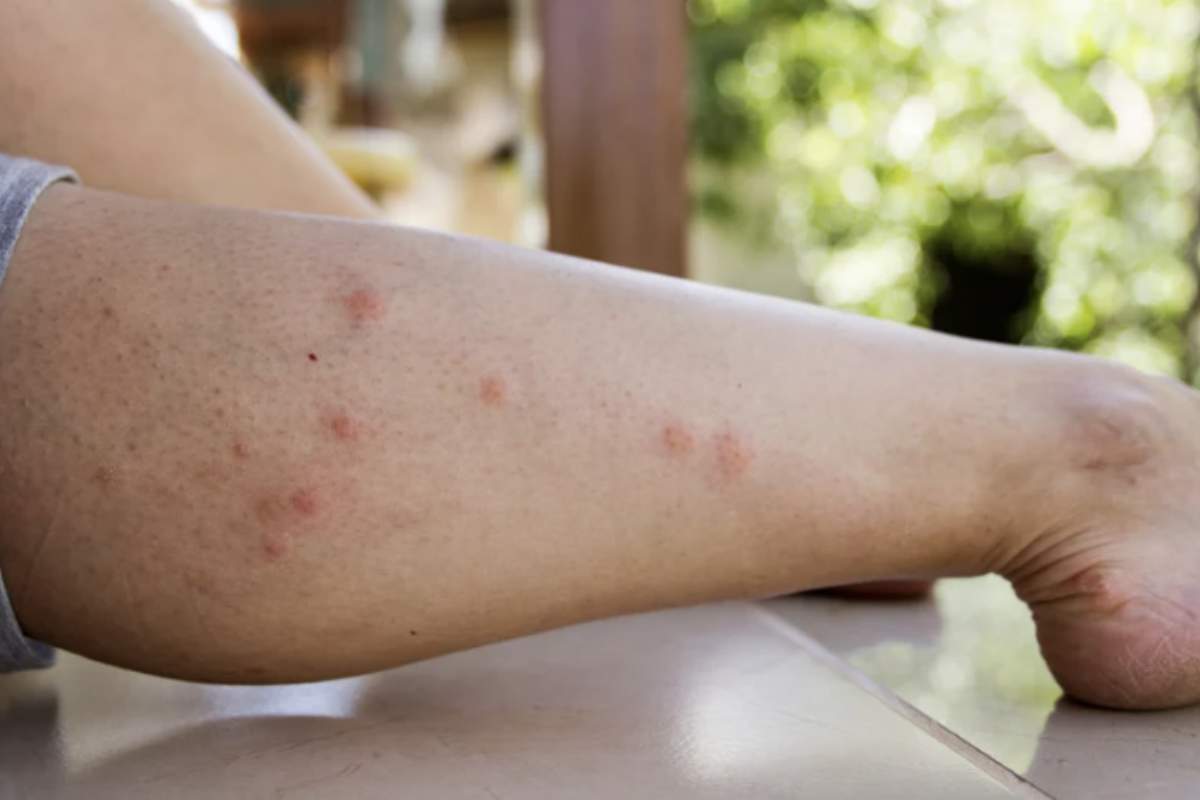È indispensabile rivolgersi al medico se dopo una puntura compaiono: