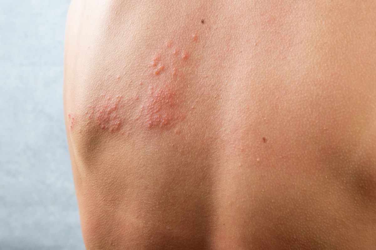 allarme spiaggia infezioni pelle come prevenire