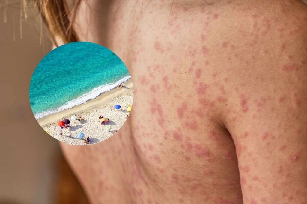 allarme spiaggia infezioni pelle