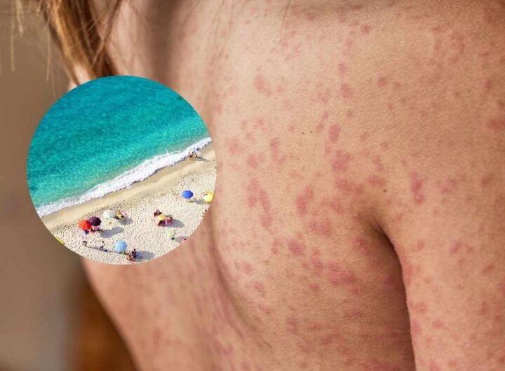allarme spiaggia infezioni pelle